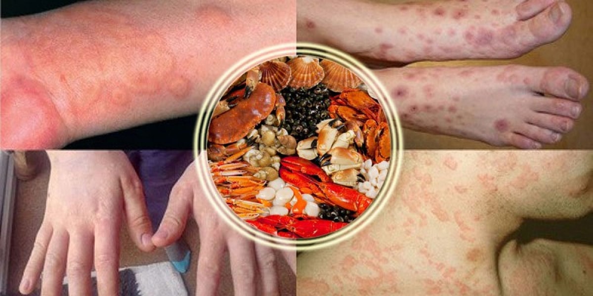 Người có cơ địa dị ứng nên thận trọng khi ăn hải sản.